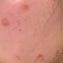 ほくろ・いぼ除去レーザー（肌） 心斎橋KT美容クリニック DAY 8 サムネイル用