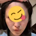 その他（口元） A CLINIC（エークリニック） 大阪院 DAY 19 サムネイル用