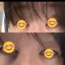 クマ治療 / 下まぶたたるみ取り / 下まぶたの脂肪取り 千葉美容外科アイビークリニック DAY 0 サムネイル用