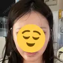 糸リフト A CLINIC（エークリニック） 大阪院 DAY 20 サムネイル用