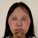 脂肪吸引（顔） Lipo Clinic omotesando DAY 2 サムネイル用