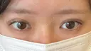 二重埋没 EMMA CLINIC（エマクリニック） DAY 6 サムネイル用