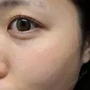 ピーリング（ニキビ・毛穴） / ピーリング（ハリ・ツヤ） / ルメッカ ハナビューティークリニック AFTER サムネイル用