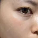 ピーリング（ニキビ・毛穴） / ピーリング（ハリ・ツヤ） / ルメッカ ハナビューティークリニック DAY 0 サムネイル用