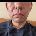 RF（高周波）たるみ治療 plume clinic DAY 0 サムネイル用