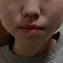 ボトックス（エラ・小顔） ルラ美容クリニック 京都院 AFTER サムネイル用