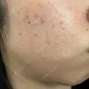 毛穴洗浄（ハイドラフェイシャルなど） / ルメッカ おおかみ美容のクリニック 新宿院 DAY 15 サムネイル用