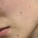 ほくろ・いぼ切除（肌） フローラクリニック DAY 5 サムネイル用