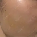 ヒアルロン酸注入（頬） Wi Clinic （ウィ クリニック）心斎橋院 DAY 4 サムネイル用