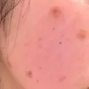 ほくろ・いぼ除去レーザー（肌） 心斎橋KT美容クリニック DAY 9 サムネイル用