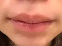 口唇縮小術 Stand by Beauty Clinic DAY 14 サムネイル用