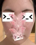 ボトックス（エラ・小顔） / ボトックス（眉間） / ボトックス（目尻） さやか美容クリニック・町田 DAY 2 サムネイル用