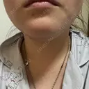 脂肪溶解注射（顔） ルラ美容クリニック 横浜院 DAY 2 サムネイル用