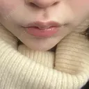 ヒアルロン酸注入（あご） / ボトックス（エラ・小顔） / ヒアルロン酸注入（唇） / ボトックス（口角） ルラ美容クリニック 大阪本院 AFTER サムネイル用