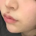 ヒアルロン酸注入（あご） / ボトックス（エラ・小顔） / ヒアルロン酸注入（唇） / ボトックス（口角） ルラ美容クリニック 大阪本院 DAY 5 サムネイル用