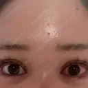 ヒアルロン酸注入（涙袋） / ほくろ・いぼ除去レーザー（肌） プライベートスキンクリニック 梅田本院 AFTER サムネイル用