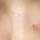 ほくろ・いぼ切除（肌） フローラクリニック DAY 6 サムネイル用