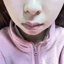 ハイフ（顔） 表参道メディカルクリニック 名古屋院 DAY 5 サムネイル用