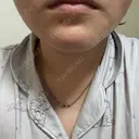 脂肪溶解注射（顔） ルラ美容クリニック 横浜院 DAY 3 サムネイル用