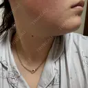 脂肪溶解注射（顔） ルラ美容クリニック 横浜院 DAY 3 サムネイル用