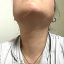 脂肪溶解注射（顔） ルラ美容クリニック 横浜院 DAY 3 サムネイル用