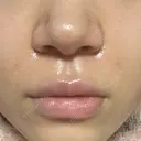 ボトックス（口角） / ヒアルロン酸注入（鼻翼基部） ルラ美容クリニック 大阪本院 DAY 1 サムネイル用