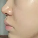 ボトックス（口角） / ヒアルロン酸注入（鼻翼基部） ルラ美容クリニック 大阪本院 DAY 1 サムネイル用