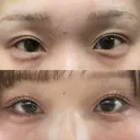 ヒアルロン酸注入（涙袋） 小倉美容外科/美容皮膚科 ビラビューティークリニック AFTER サムネイル用
