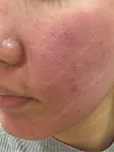 ポテンツァ 渋谷美容外科クリニック 横浜院 DAY 0 サムネイル用