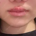ヒアルロン酸注入（唇） / ボトックス（タレ目） ルラ美容クリニック 仙台院 / ルラスキンクリニック 仙台院 DAY 1 サムネイル用