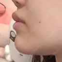 ヒアルロン酸注入（唇） / ボトックス（タレ目） ルラ美容クリニック 仙台院 / ルラスキンクリニック 仙台院 DAY 1 サムネイル用