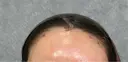 脂肪注入（肌） / 脂肪注入（額） ルラ美容クリニック 岡山院 AFTER サムネイル用