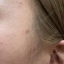 ほくろ・いぼ除去レーザー（肌） Fellez Clinic【フェルズクリニック】 DAY 70 サムネイル用