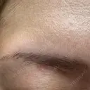 ほくろ・いぼ除去レーザー（肌） Fellez Clinic【フェルズクリニック】 DAY 70 サムネイル用