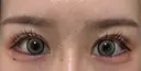 目尻切開 / タレ目形成・グラマラスライン（切開） BIANCA銀座 DAY 14 サムネイル用