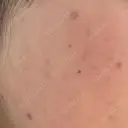 ほくろ・いぼ除去レーザー（肌） 心斎橋KT美容クリニック AFTER サムネイル用