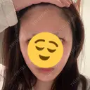 糸リフト A CLINIC（エークリニック） 大阪院 DAY 22 サムネイル用