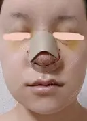 隆鼻術 / 鼻尖形成（切開） / 鼻中隔延長（切開） / 軟骨移植 / 骨切幅寄せ / 鼻孔縁挙上 / 鼻翼基部形成（貴族手術） / 鼻柱下降・鼻唇角形成（猫手術） WOM CLINIC GINZA （ワム クリニック ギンザ） DAY 4 サムネイル用