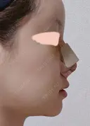 隆鼻術 / 鼻尖形成（切開） / 鼻中隔延長（切開） / 軟骨移植 / 骨切幅寄せ / 鼻孔縁挙上 / 鼻翼基部形成（貴族手術） / 鼻柱下降・鼻唇角形成（猫手術） WOM CLINIC GINZA （ワム クリニック ギンザ） DAY 4 サムネイル用