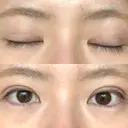 二重埋没 / 上まぶたの脂肪取り アリエル美容クリニック 郡山院 DAY 42 サムネイル用