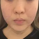 その他（肌） / インモード 東京美容皮膚科アロエクリニック池袋 DAY 0 サムネイル用