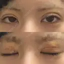 二重埋没 形成外科と美容外科のクリニック池袋 DAY 3 サムネイル用