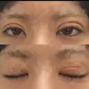 二重埋没 形成外科と美容外科のクリニック池袋 DAY 4 サムネイル用