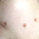 ほくろ・いぼ切除（肌） フローラクリニック DAY 7 サムネイル用