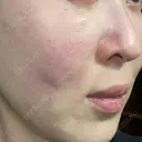 スネコス ミニマムスキンクリニック池袋 DAY 1 サムネイル用