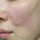 スネコス ミニマムスキンクリニック池袋 DAY 1 サムネイル用