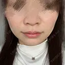 ボトックス（エラ・小顔） / RF（高周波）たるみ治療 大美会クリニック 梅田院 DAY 4 サムネイル用