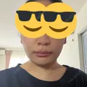 脂肪吸引（顔） 4Dクリニック DAY 1 サムネイル用