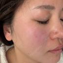 ルメッカ BITO BEAUTY CLINIC DAY 6 サムネイル用