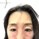 スネコス Natural Skin Clinic 自由ヶ丘院 AFTER サムネイル用
